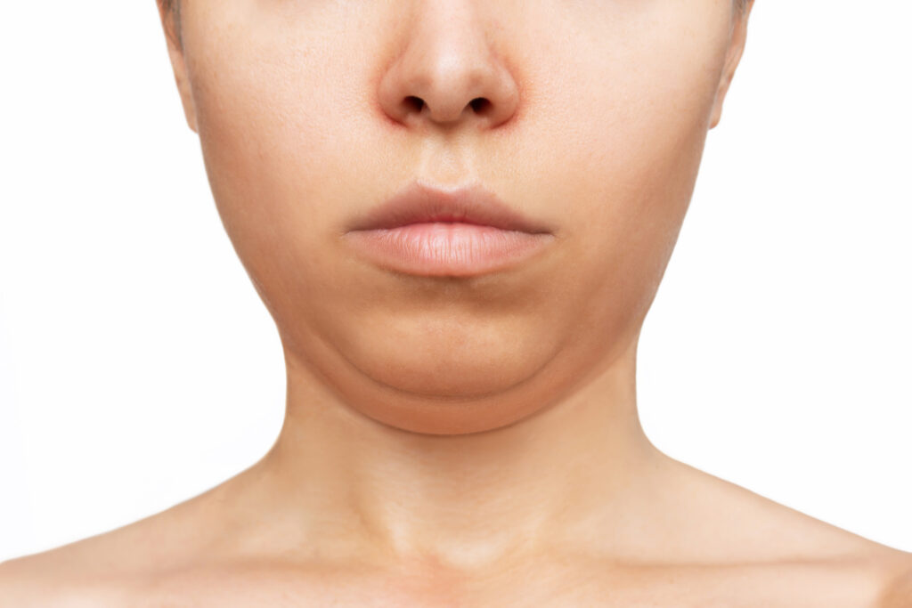 脂肪冷却は顔痩せ（二重顎・小顔）に効果ある？必要回数・リスクについて徹底解説