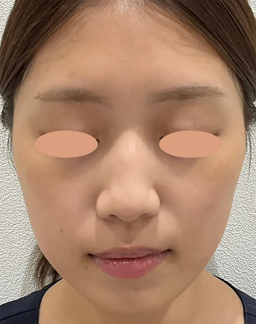 症例写真アフター