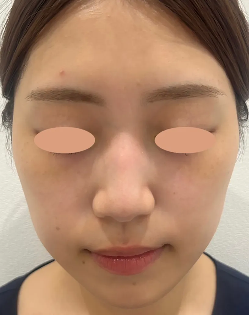 症例写真ビフォー