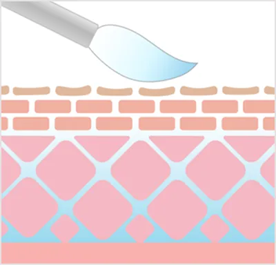 ケミカルピーリングの効果2