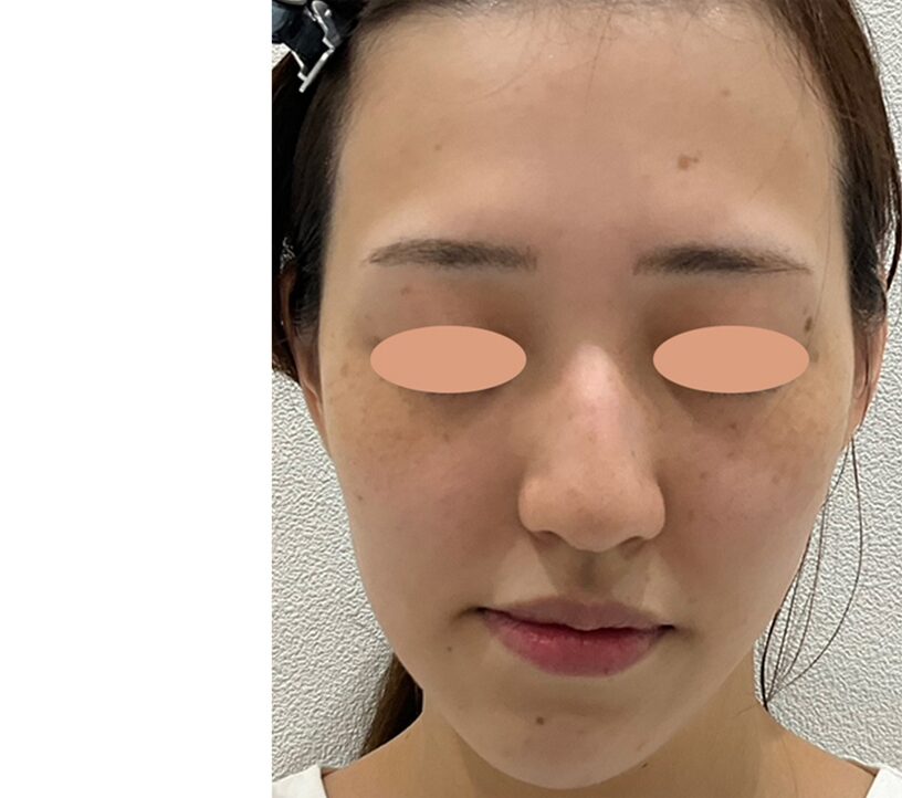 症例写真ビフォー