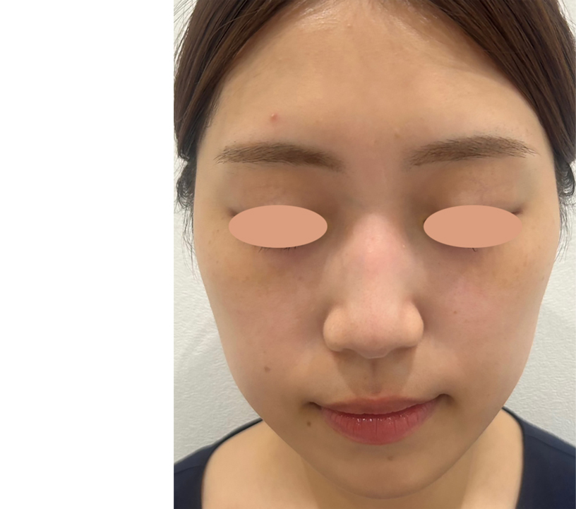 症例写真ビフォー