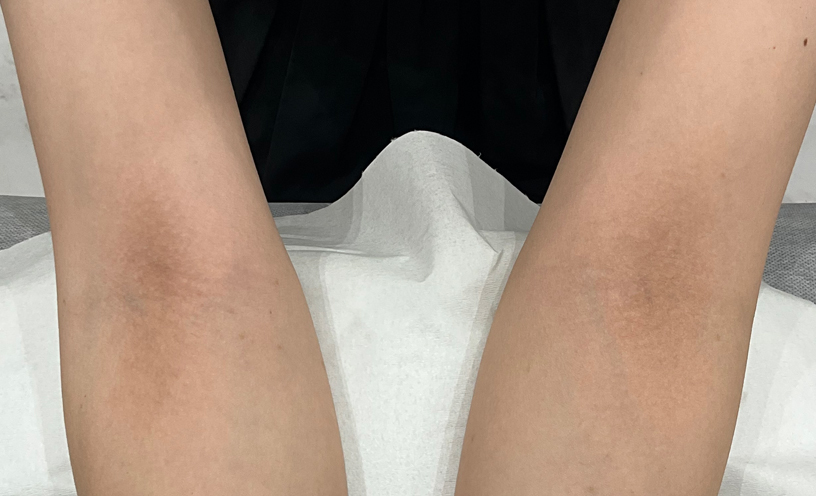 症例写真ビフォー