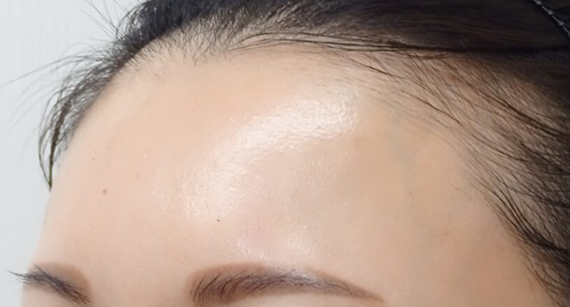 症例写真アフター