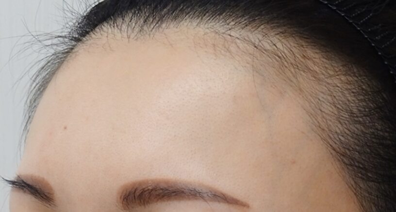 症例写真ビフォー