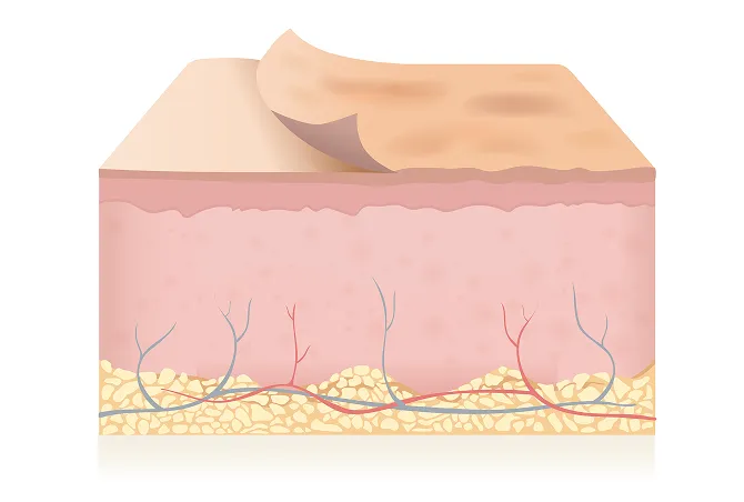 サリチル酸マクロゴールピーリング（ニキビピーリング）